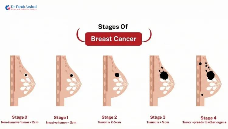 Breast Cancer Stages 0 to 4: Complete Survival Guide
